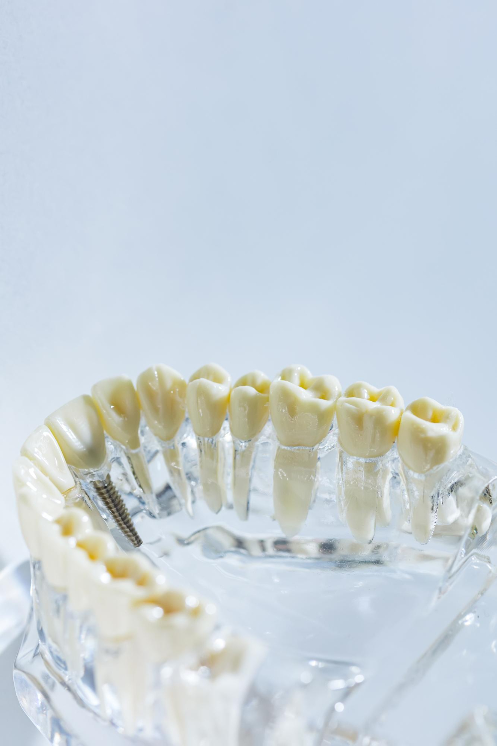 Dental Crowns
