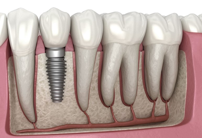 Implant Dentistry
