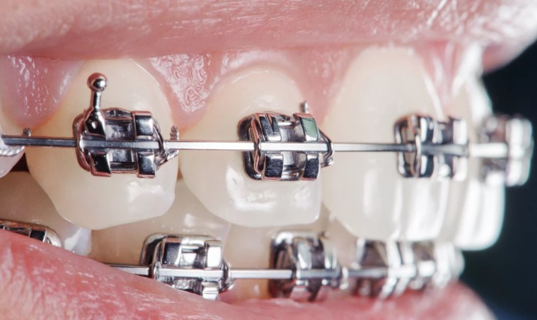 Orthodontic Braces